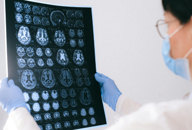 How Is Alzheimer’s Disease Treated?